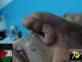 Rhinophyma-270119-1