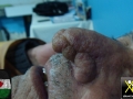 Rhinophyma-270119-2
