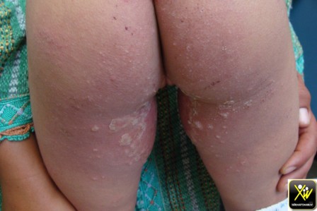 Syndrome de Lyell staphylococcique, Scalded skin syndrome