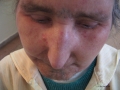 Sclerodermie.