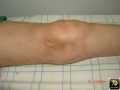Sclerodermie.