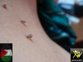 Acanthosis-nigricans-et-skin-tag-080814-61