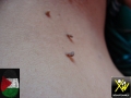 Acanthosis-nigricans-et-skin-tag-080814-62