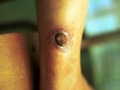 Tuberculose cutanée verruqueuse.