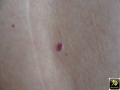 Taches rubis.