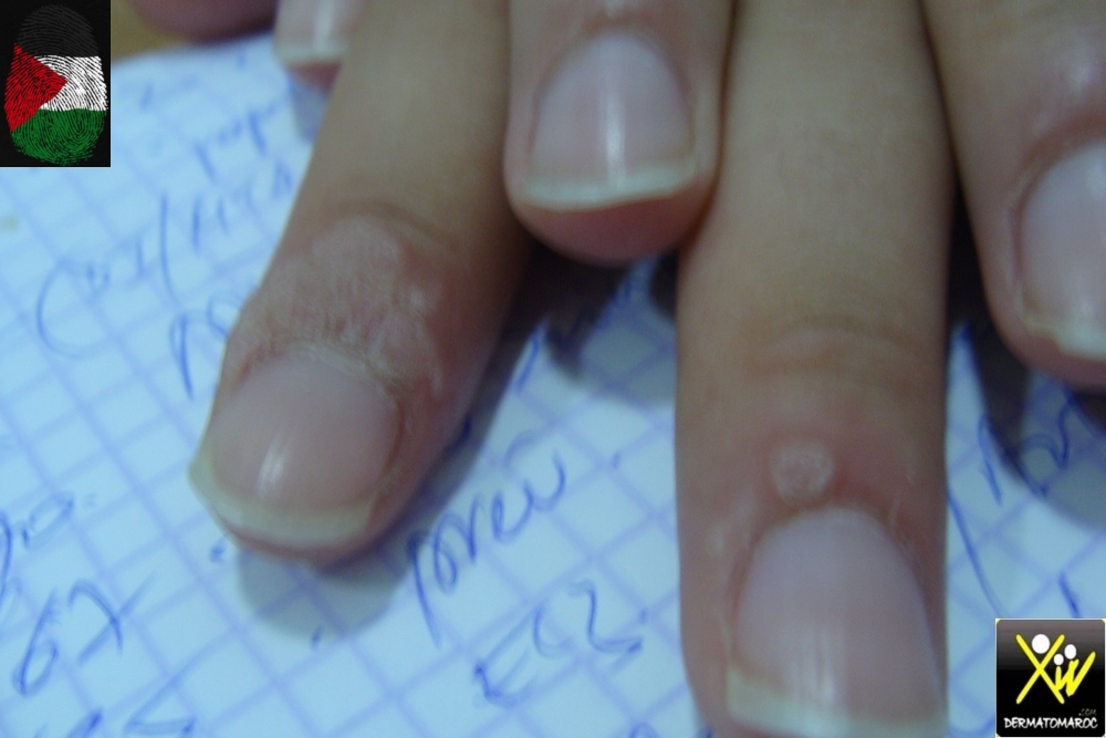 Verrues-periungueales-12092026-1