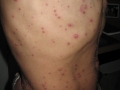 Varicelle.