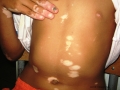Vitiligo.