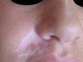 Vitiligo segmentaire.