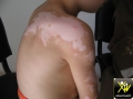 Vitiligo segmentaire.