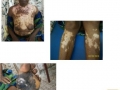 Vitiligo. et mélanome plantaire.