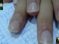 Verrues-periungueales-12092026-1