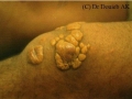 Xanthomatose.