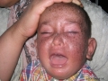 Xeroderma pigmentosum.