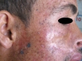 Xeroderma pigmentosum.