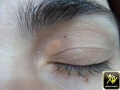 Xanthelasma.
