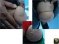 Xanthomatose