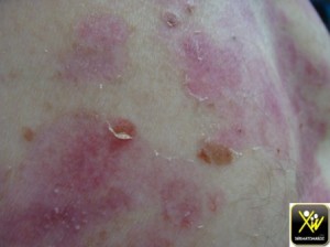 Dermatose bulleuse et cicatr gr milium 180515  (8) (Copier)