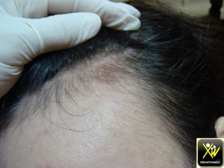 Alopecie triangulaire Cg 180515  (1) (Copier)
