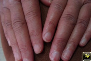 Le phénomène de Raynaud et des telangiectasies.