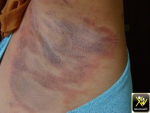 Prurit aux aisselles