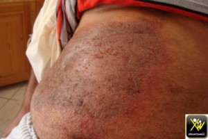 Prurit sous le pansement