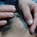 alopecie-triangulaire-congenitale-patietotemporal