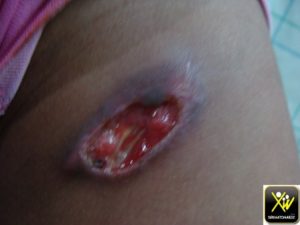 Ulcération résistante