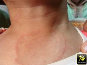 Érythème centrifuge prurigineux