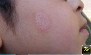 Plaques erythemato squameuses