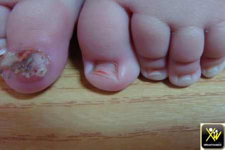 Ongle Incarne Du Nourisson Dermatomaroc