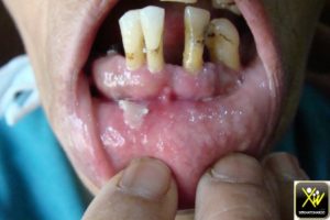 L'ulcération gingivale chronique