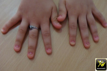 dysplasie-ectodermique-hereditaire-deux-soeurs-atteintes-a-differencier-du-nail-patella-syndrome-200916-2-copier