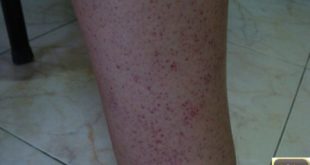 Purpura aigu apyrétique.