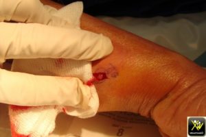 Douleur de l'avant bras.