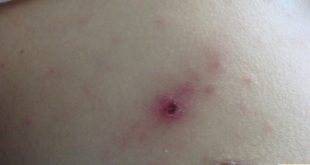 Exanthème fébrile et croûte noirâtre.