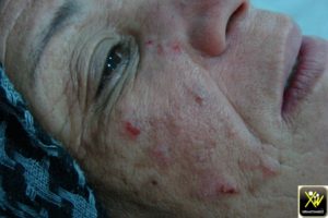 Excoriations du visage et chute des sourcils.