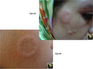 Des plaques érythémateuses faciales.