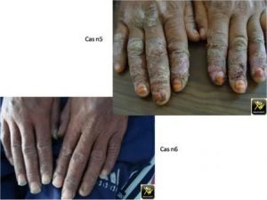 Des mains et des pieds squamo crouteux