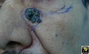 Tumeur pigmentée du visage.