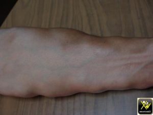 Tumeur fermes diffuses.