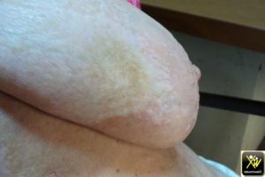 Macules et plaques nacrées.