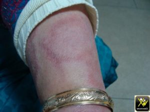 Érythème centrifuge avec anesthésie locale