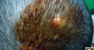 Nodule lisse et dur du cuir chevelu