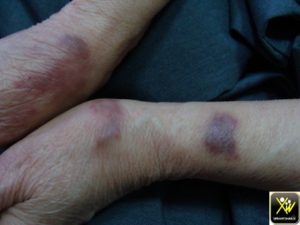 Tumeurs et plaques violacées.