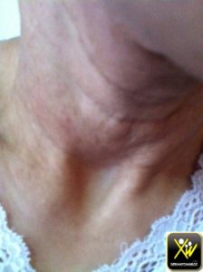 Des plis avec des papules jaunâtres.