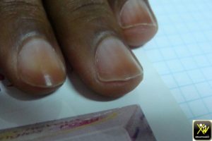 Pigmentation acquise des ongles.