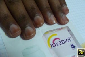 Pigmentation acquise des ongles.