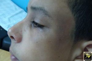 Pigmentation périorbitaire.