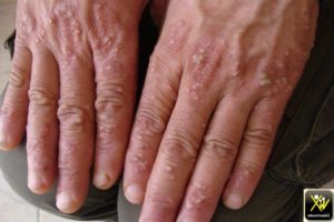 Pustulose aigue palmaire.